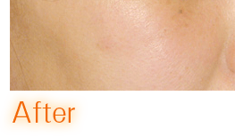マリアクリニックの美肌再生レーザーフェイシャルの赤ら顔症例アフター