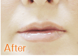 マリアクリニックの唇のヒアルロン酸注射症例アフター